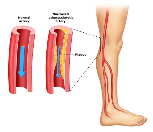 Upper & Lower Extremity Arterial Insufficiency