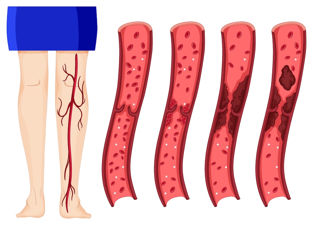 Peripheral Vascular Disease